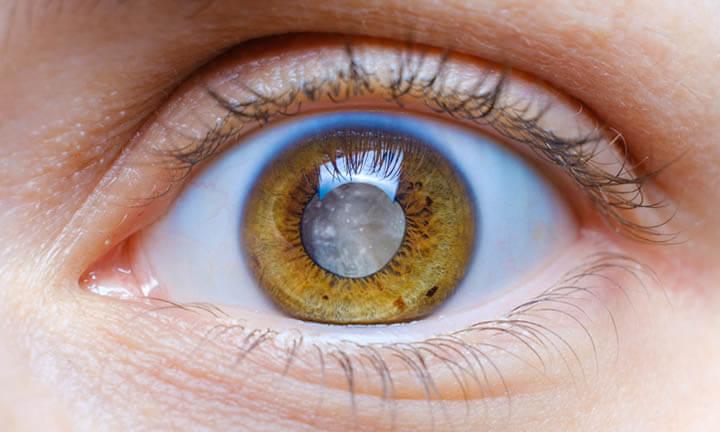 Bei Augenkrankheiten leidet auch die Lebensqualität.