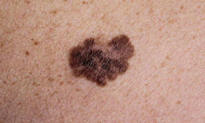 Photos of melanoma without magnification and with a tenfold magnification using a dermatoscope