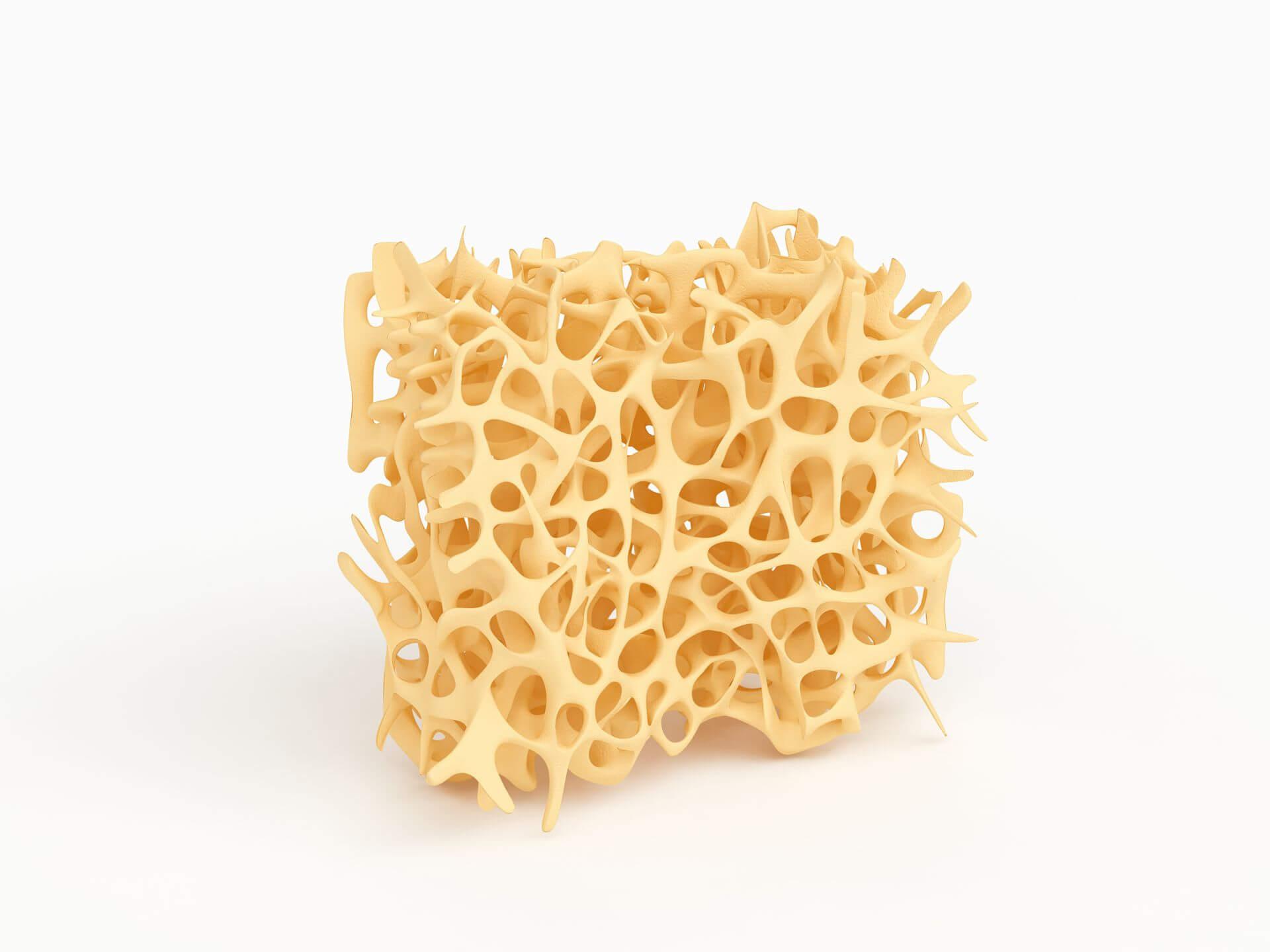 Romosozumab ist in der Schweiz bis 2023 bedingt zugelassen für Patientinnen mit schwerer Osteoporose