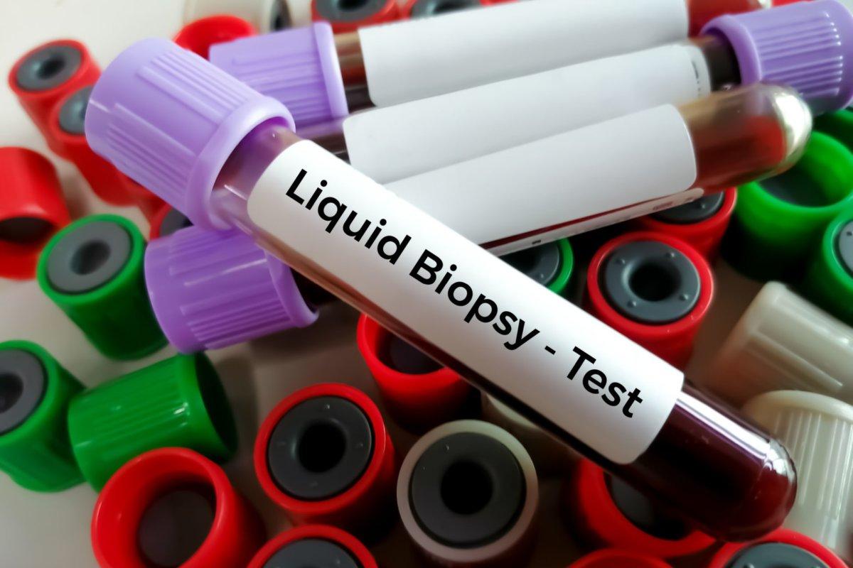 Am USZ steht erstmals die Liquid biopsy zur Verfügung.