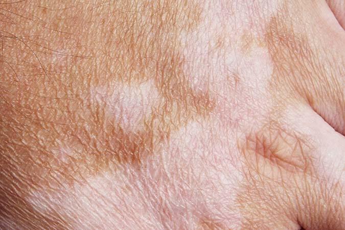 Vitiligo ist eine Erkrankung, die eine Depigmentierung von Hautflecken verursacht