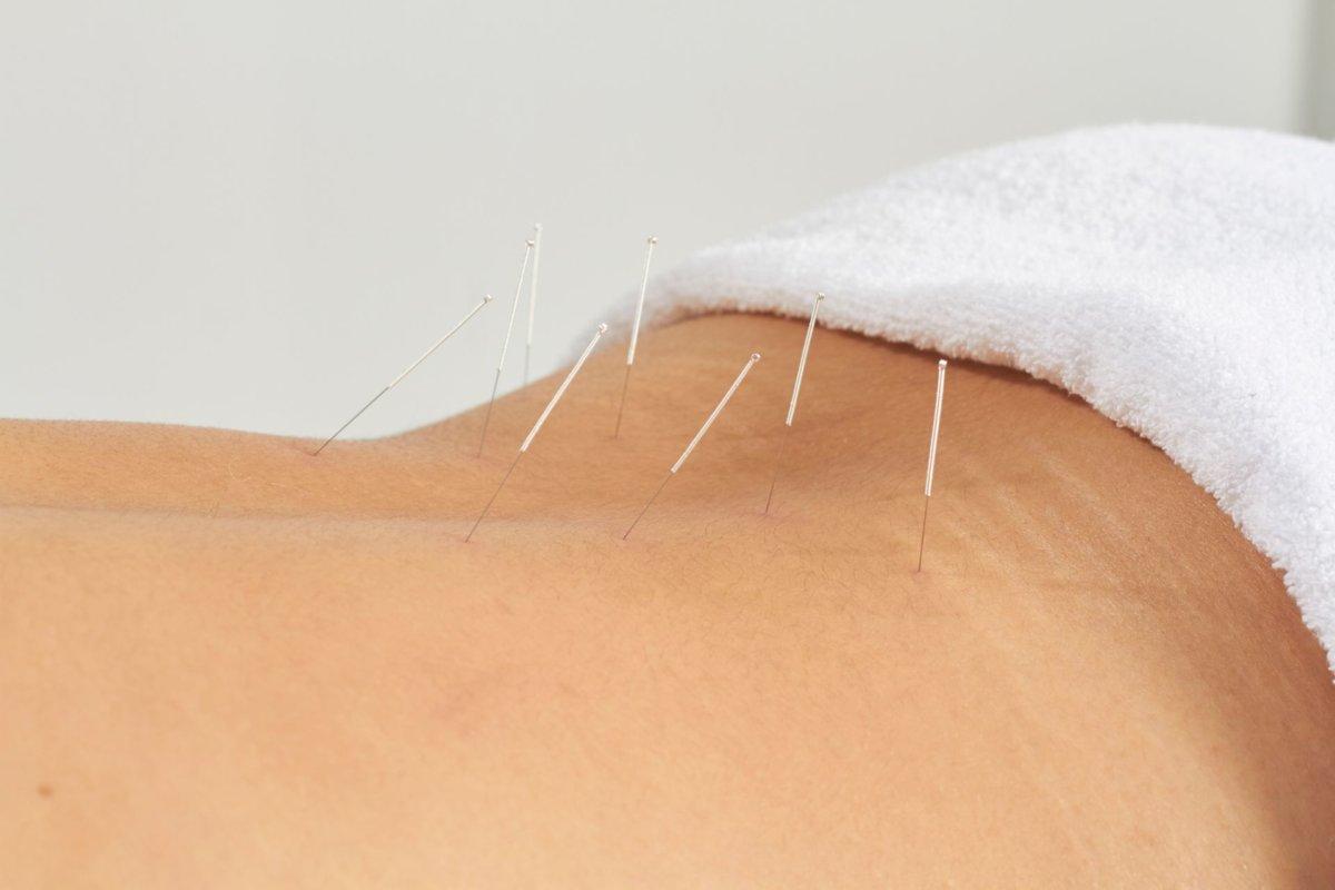 Bei chronischen Schmerzen der Lendenwirbelsäule hilft die Akupunktur vielen Menschen.