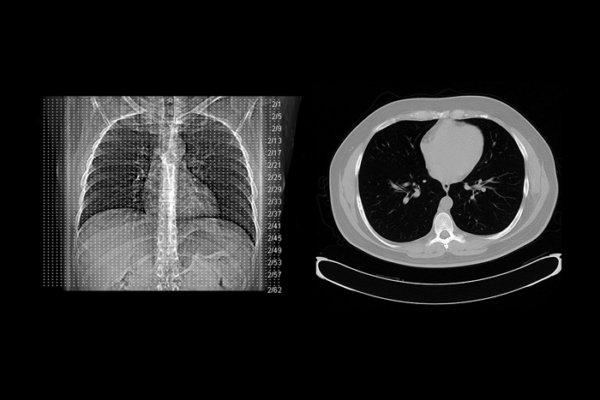 CT-Aufnahme des Thorax im Zuge eines Lungenkrebs-Screening.
