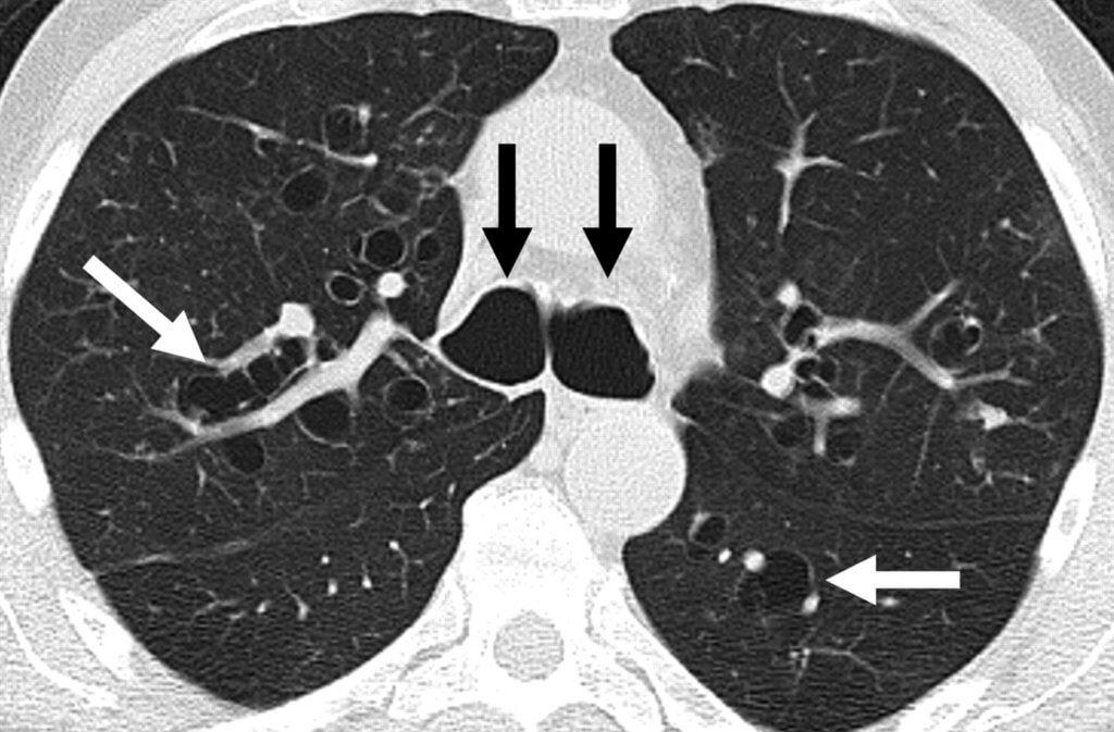 Das CT der ABPA-Patientin zeigte zentrale Bronchiektasen.