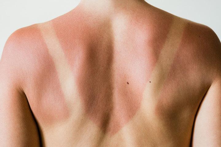 Nahaufnahme von Sonnenbrandflecken auf dem Rücken einer Frau