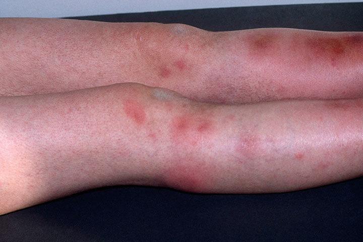 Beine mit Erythema nodosum