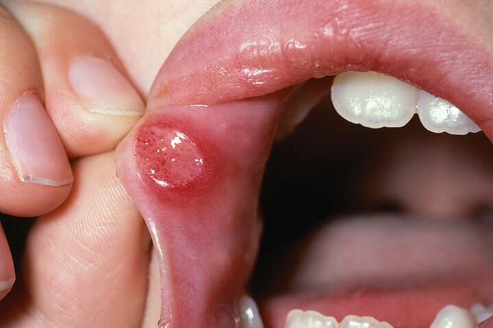 Bei Ulzerationen im Mund sollte auch an einen M. Crohn gedacht werden.