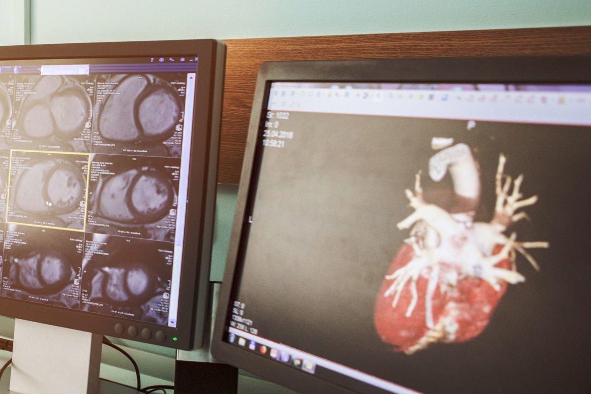 Das Herz-CT kann einen Überblick darüber geben, ob eine KHK vorliegt.
