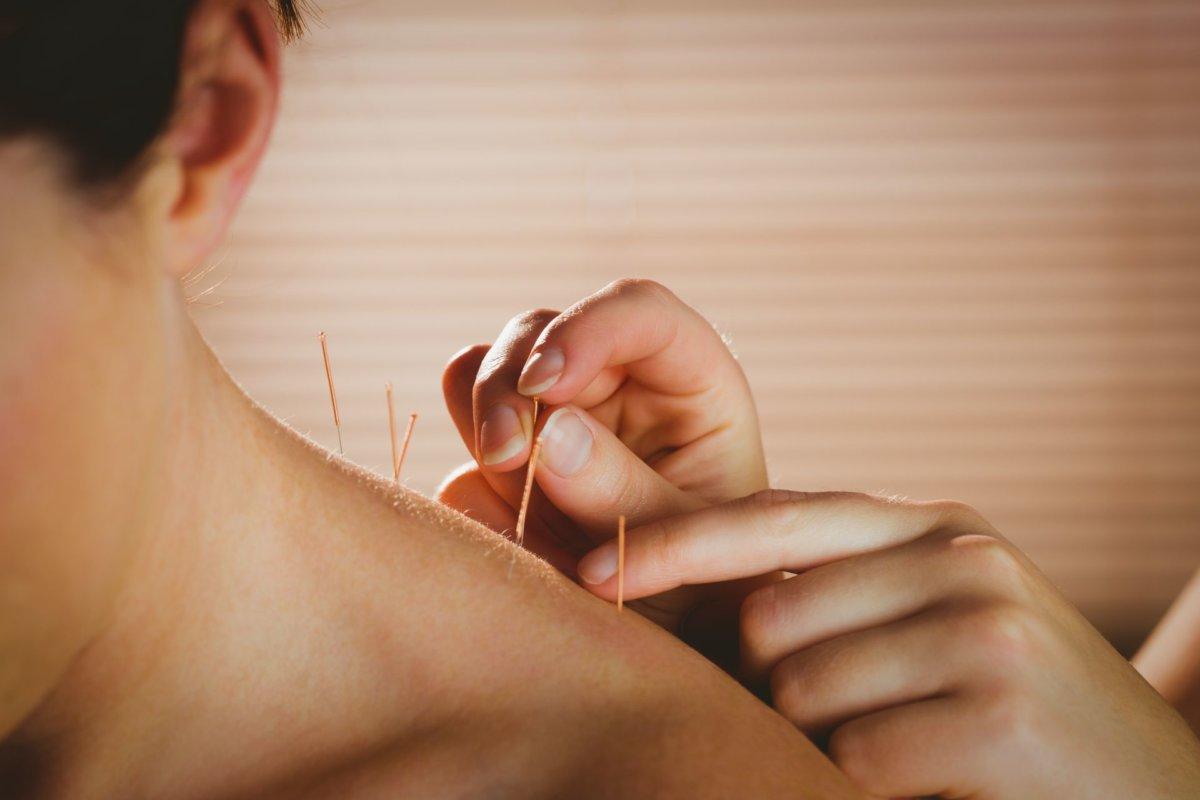 Eine der Säulen beim chronischen primären Schmerzsyndrom ist die Akupunktur.
