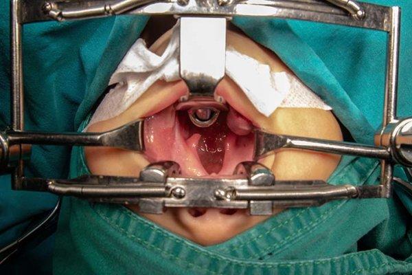 Geöffneter Mund während Operation einer Lippen-Kiefer-Gaumen-Spalte.