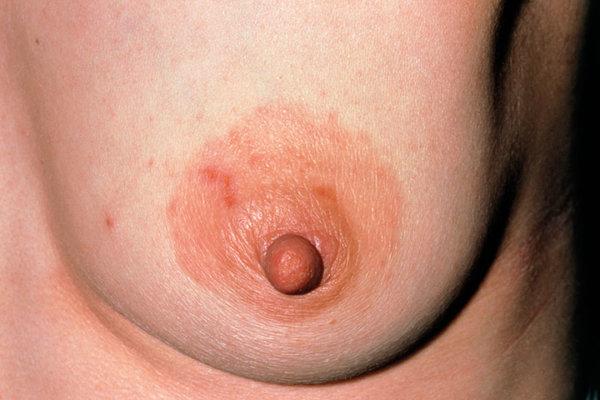 Weibliche Brust mit Nippelekzem.