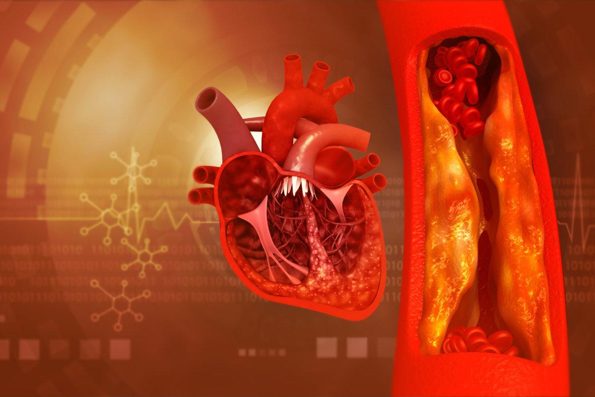 Blocked blood vessel, artery with human heart anatomy. 3d illustration