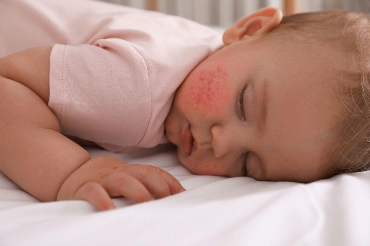 Eine atopische Dermatitis führt bei Kindern und Erwachsenen oft zu Schlafproblemen.