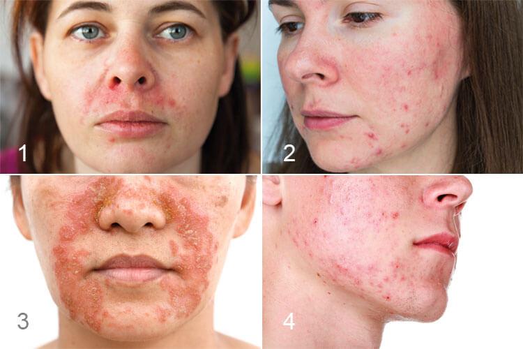 Vier Bilder von Frauen mit dermatologischen Krankheiten im Gesicht.