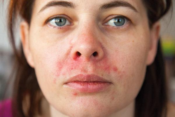 Das Gesicht einer Frau mit perioraler Dermatitis.