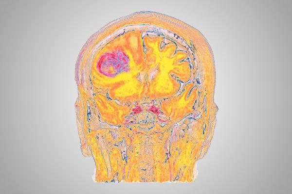 Gehirnscan eines Patienten mit Metastase