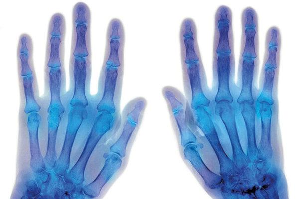 Roentgenbild zweier Hände mit rheumatischer arthritis