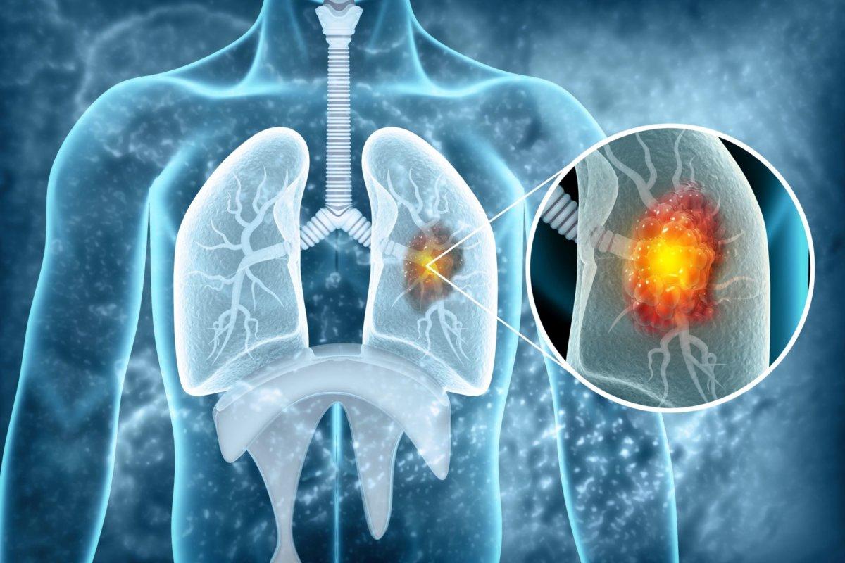 Auch bei langfristiger Nachbeobachtung zeigt die Checkpoint-Inhibition beim Lungenkrebs Vorteile.