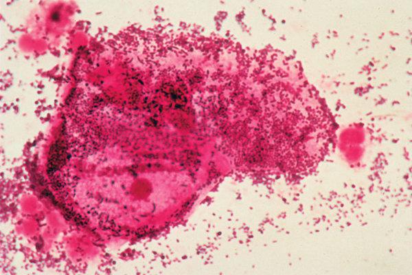 Mikroskopische Aufnahme einer bakteriellen Vaginose