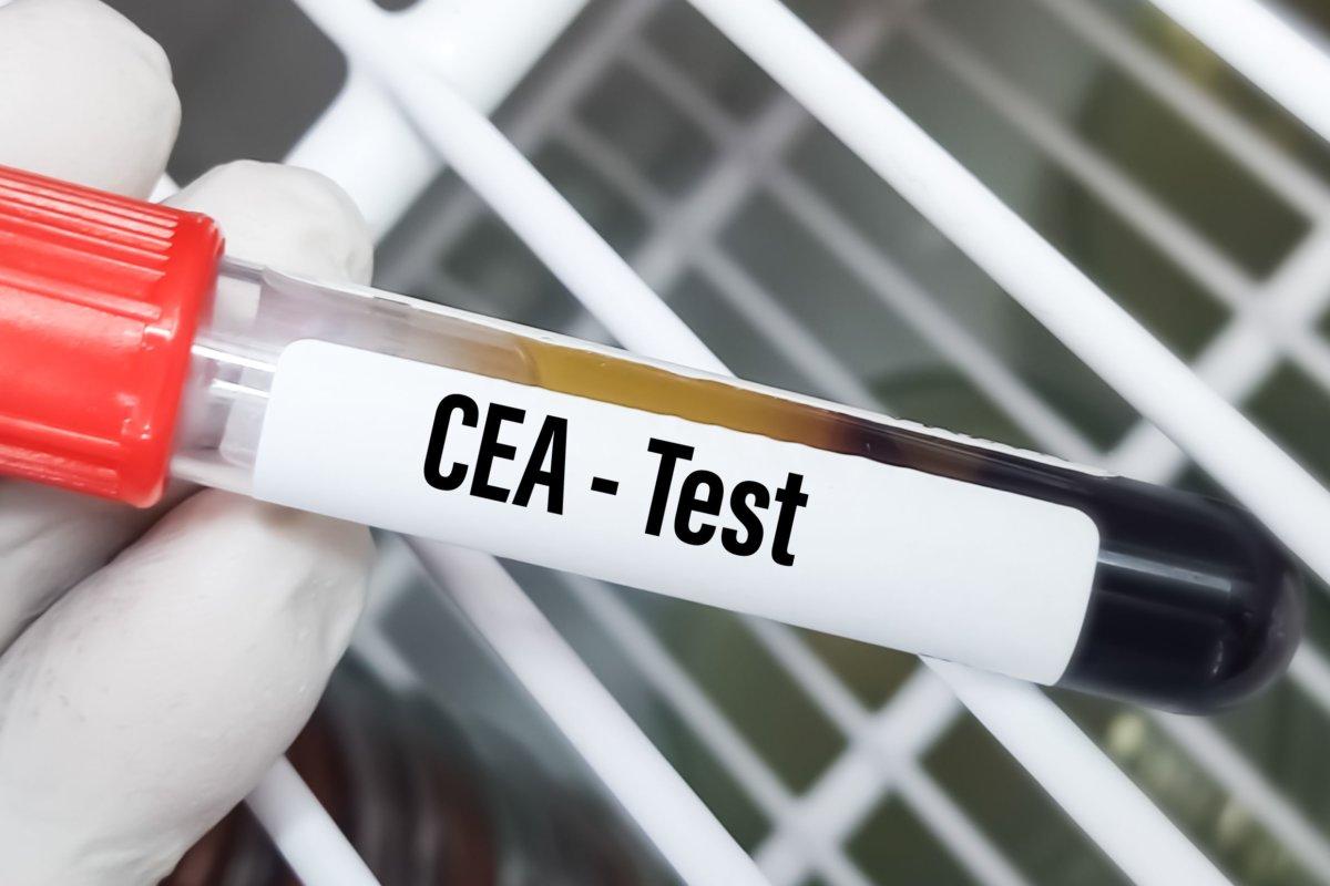 ctDNA und CEA könnten bald zur Einschätzung von Kolonkarzinomen verwendet werden.