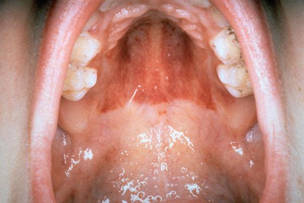 Nahaufnahme offener Mund mit Schleimhautblutungen