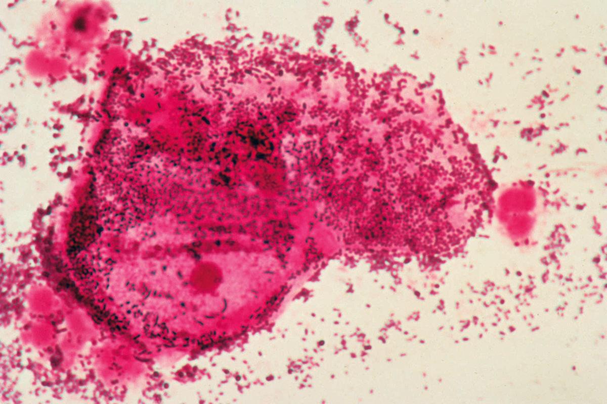 Bacterial vaginosis,cervical smear