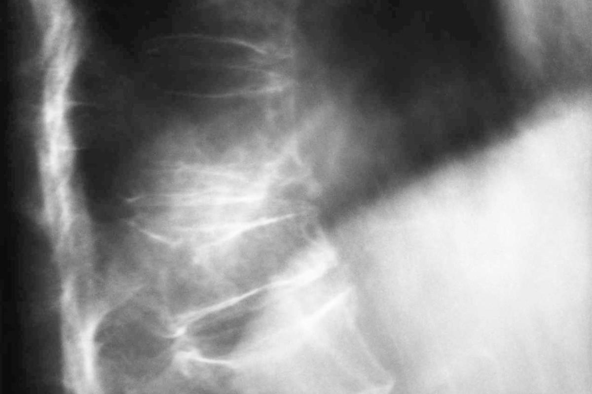 X-ray showing fractured spine due to osteoporosis