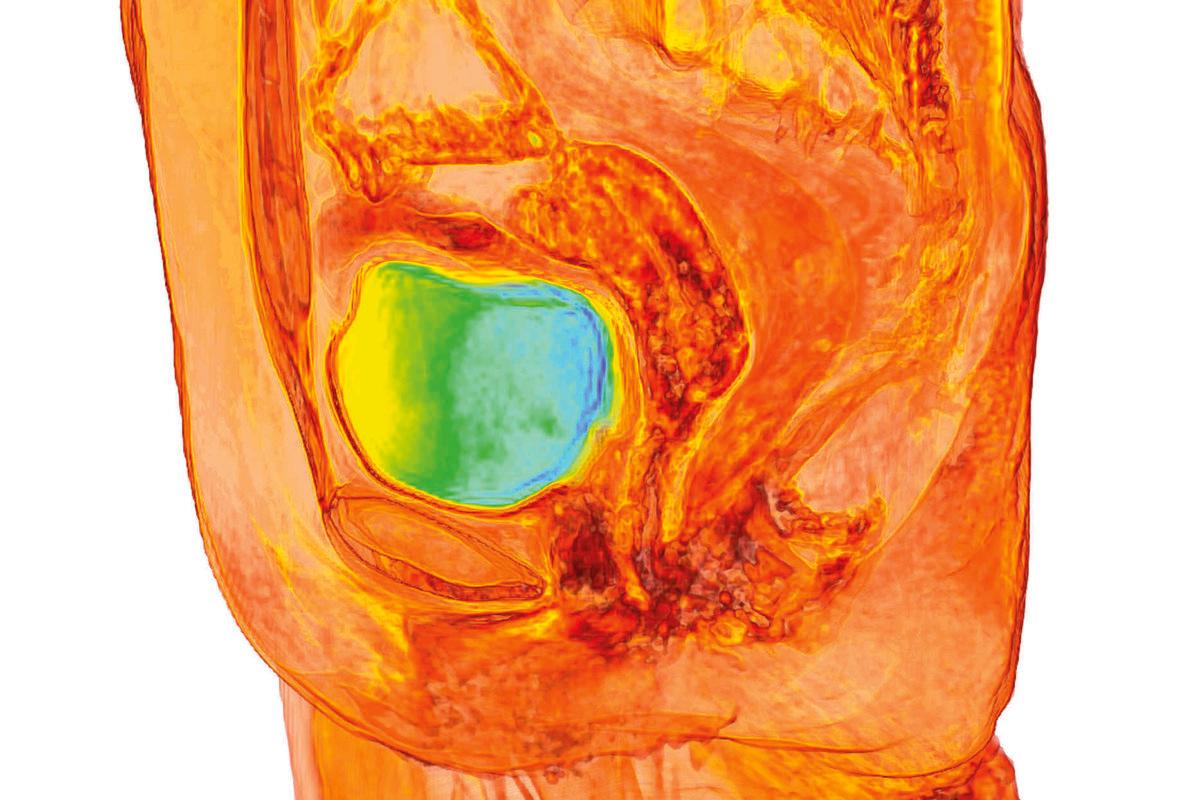 Female bladder, 3D MRI scan