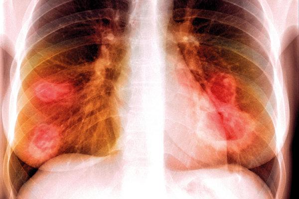 Roentgenbild einer Lunge mit nekrotisierenden Läsionen aufgrund Granulomatose mit Polyangiitis