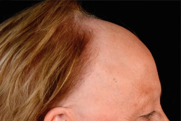 Weiblicher Kopf von der Seite mit frontal fibrosierender Alopezie