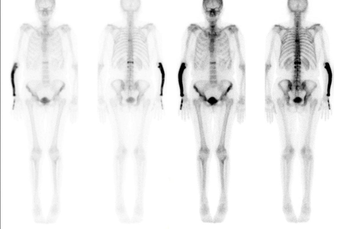 Knochenszintigrafie mit typischem Befund beim Paget-Syndrom
