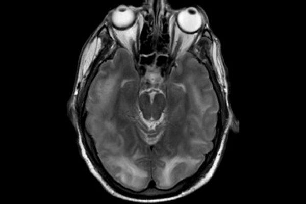 MRI eines Gehirns mit posteriore reversible Enzephalopathie