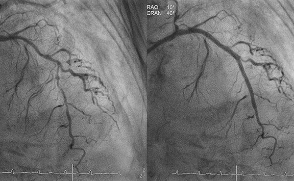 Comparaison de l'intervention coronarienne percutanée (ICP) pré-post au niveau de l'artère descendante antérieure gauche (LAD) proximale et moyenne avec un stent à élution médicamenteuse (DES)