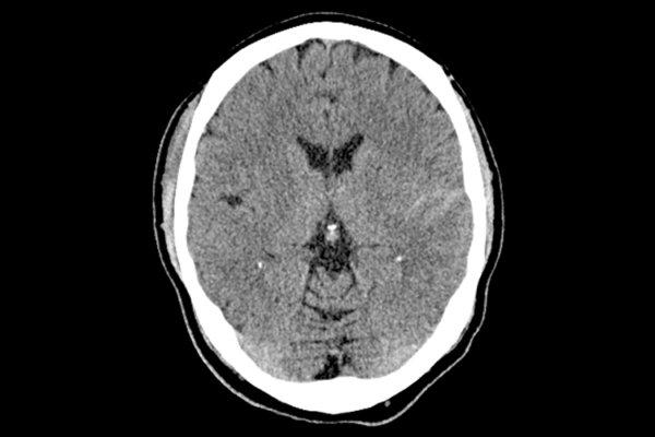 CT eines Gehirns mit subduralen Hämatomen aufgrund Schädel-Hirn-Trauma