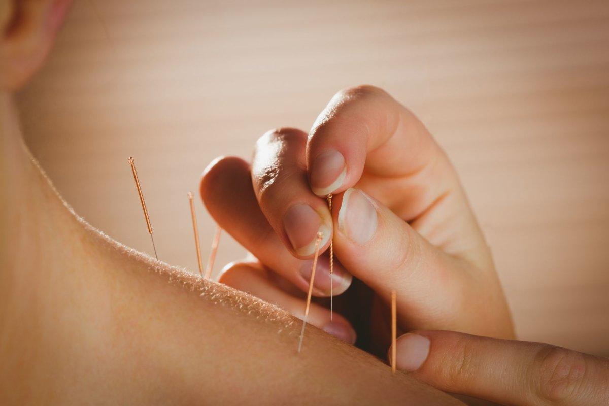 Pour la fibromyalgie, l'acupuncture est egalement recommandée dans les directives S3