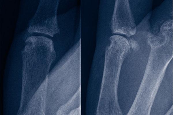 Zwei verschiedene Roentgenbilder eines Daumens mit und ohne rheumatoide Arthritis
