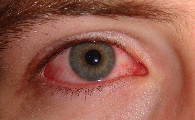 Die Konjunktivitis ist die häufigste Erkrankung des Auges in der Hausarztpraxis.