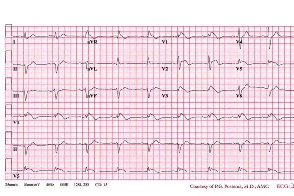 EKG Kardiogramm
