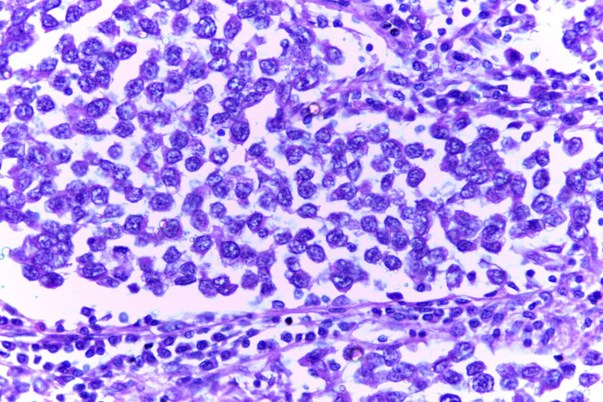 Bei diesem Seminom macht sich der Tumor durch Lobuli aus uniformen Zellen bemerkbar, die durch feine bindegewebige Septen getrennt sind.