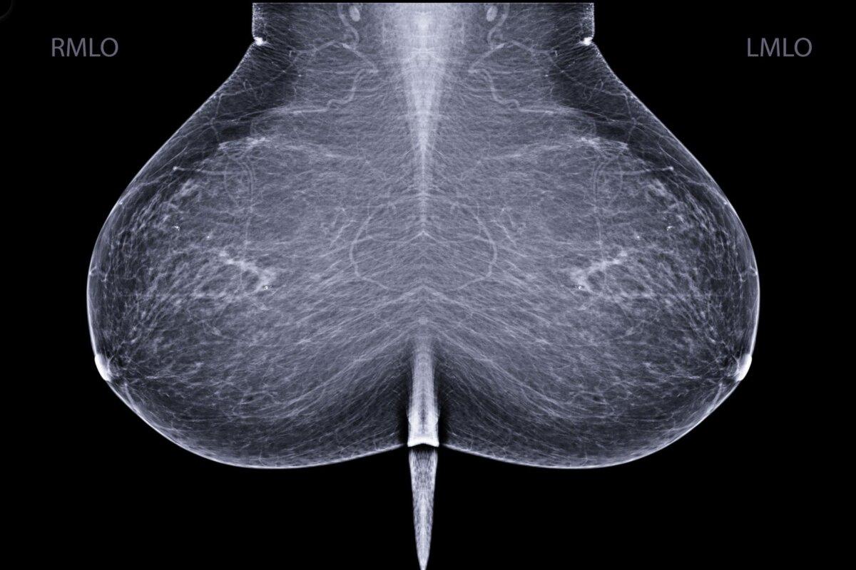 Worin unterscheidet sich das Mammogramm der linken von der rechten Brust? Das liest das Programm AsymMirai aus.