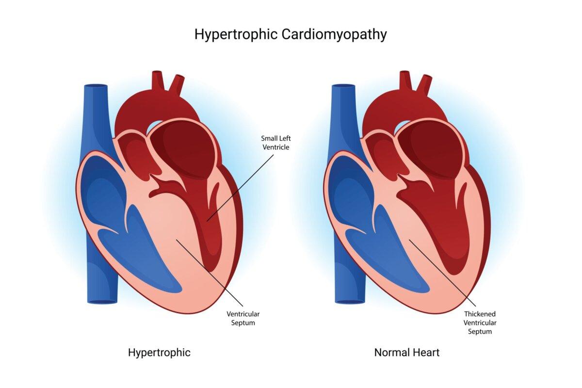 Le mavacamten est une des dernières options pour la cardiomyopathie hypertrophique.