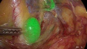 Sentinel-Lymphknoten mit positiver ICG-Färbung beim Zervixkarzinom.